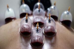 حجامت توسط افراد غیر متخصص خطرناک است