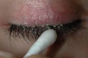 کاشت مژه عامل بروز انگل‌های پوستی