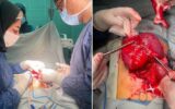 جراحی موفقیت‌آمیز خارج کردن تومور شکمی از بدن یک کودک